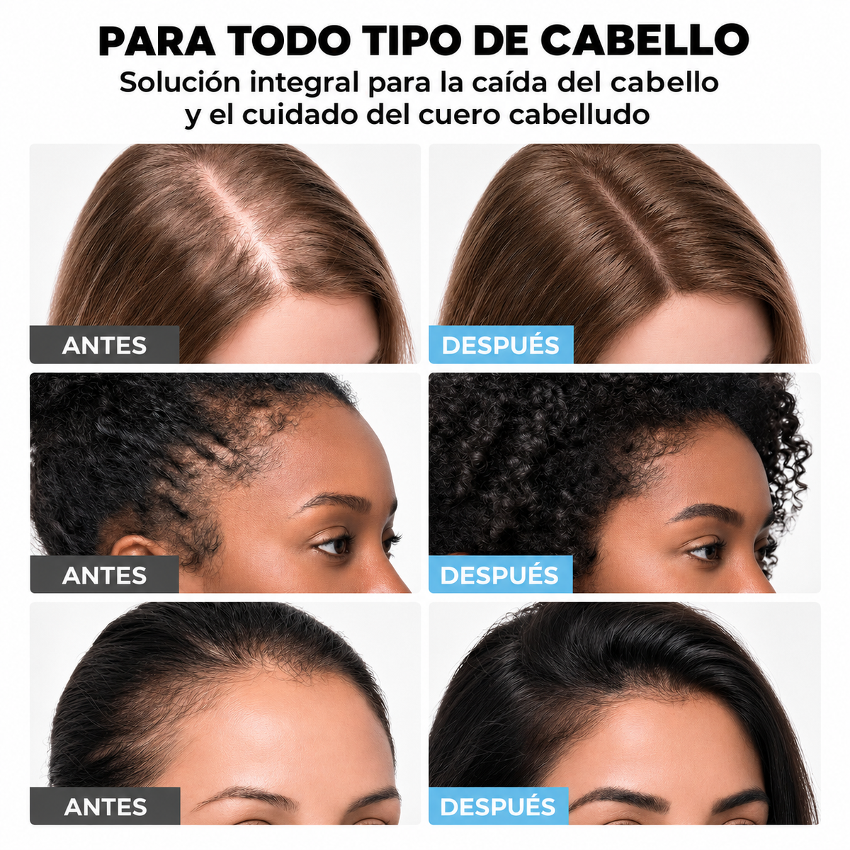 Crema Anticaída Minoxidil 5%