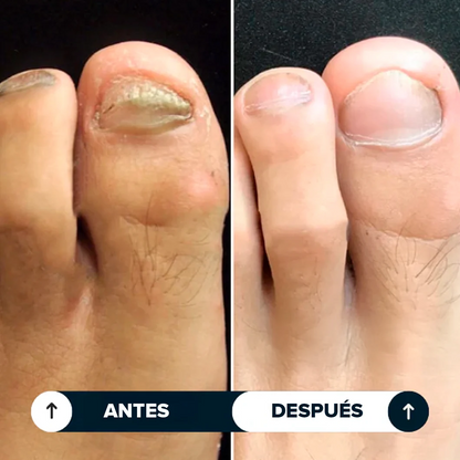 Lápiz Antifúngico®