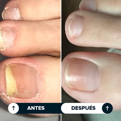 Lápiz Antifúngico®